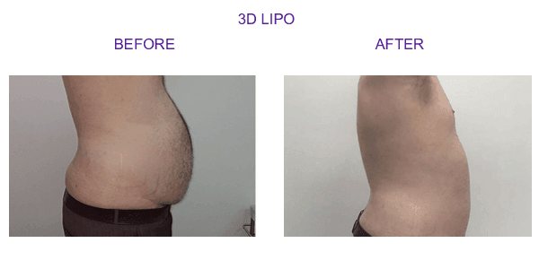 3dlipo1