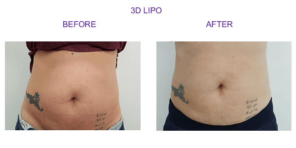 3dlipo2