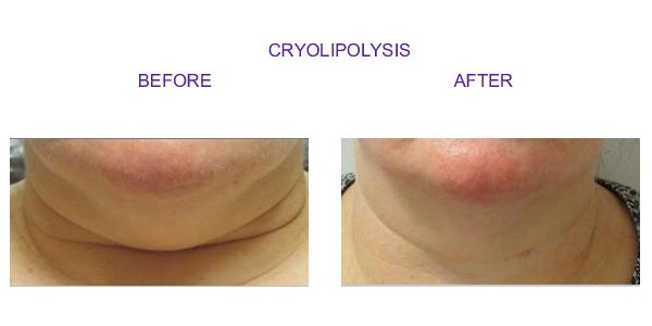 cryolipolysis1