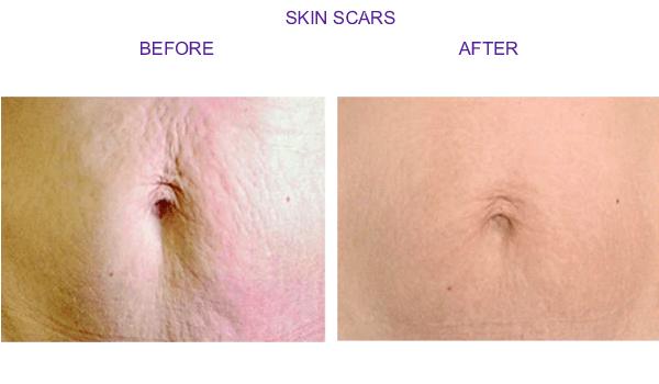 skinscar2